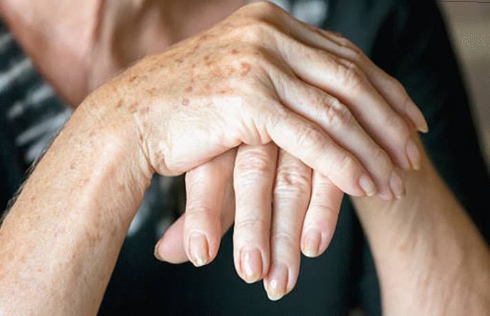 Comment Enlever Les Taches Brunes Sur Les Mains - 8 Remèdes Naturels ...